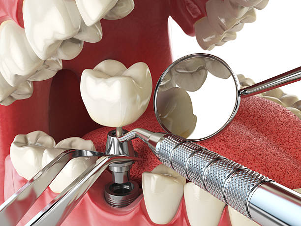 Best Emergency Root Canal Treatment in Yellow Springs, OH