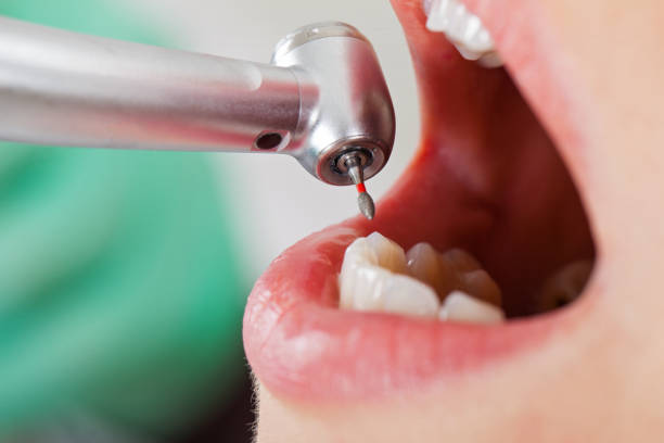 Best Emergency Broken Tooth Repair in Yellow Springs, OH